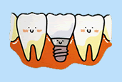 健康な歯をまったく削ることなく、歯の無い部分にインプラントを入れます。